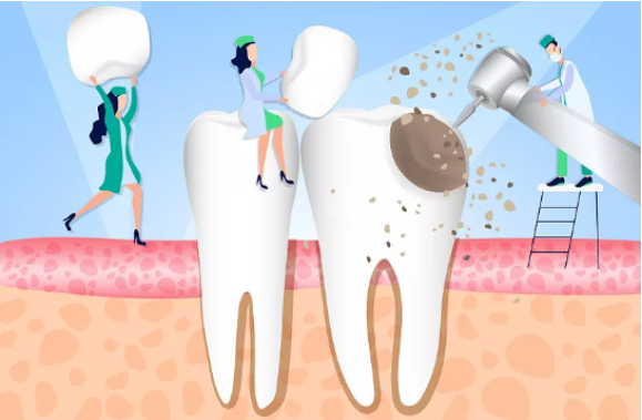 最新研究|微酸性次氯酸電解水對(duì)口腔充填材料性能的影響(圖1)
